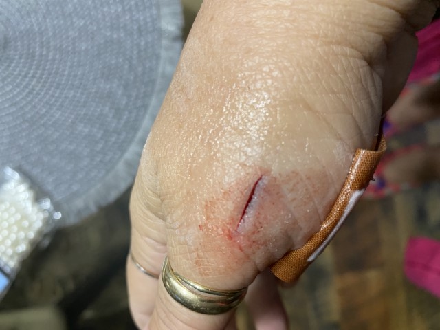 Injury (Before Treatment)