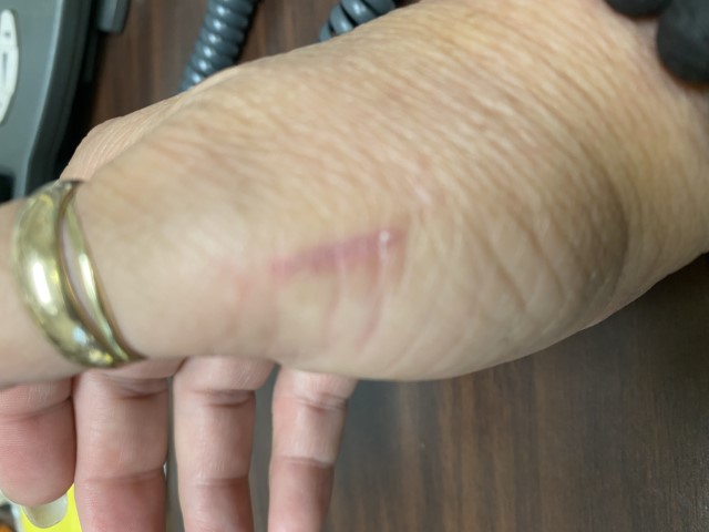 Injury ( 4 Days After Treatment)